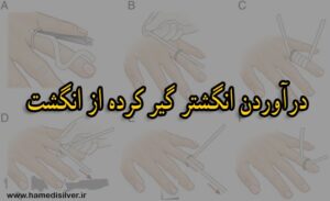  نحوه درآوردن انگشتر گیر کرده از انگشت