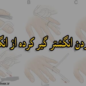  نحوه درآوردن انگشتر گیر کرده از انگشت